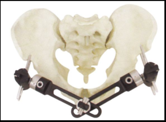 连续碳纤维增强peek在骨外固定支架中的应用优势